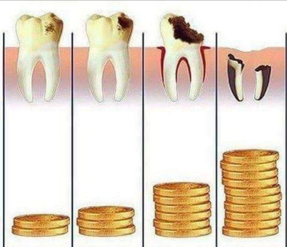 충치 진행 과정과 비용