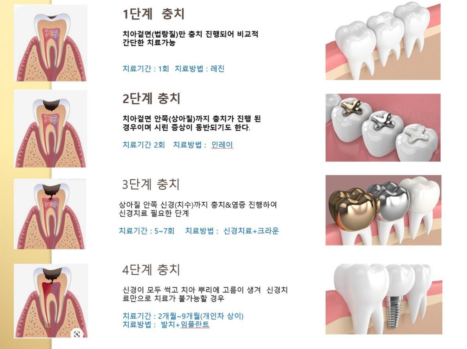 충치치료 단계별 설명